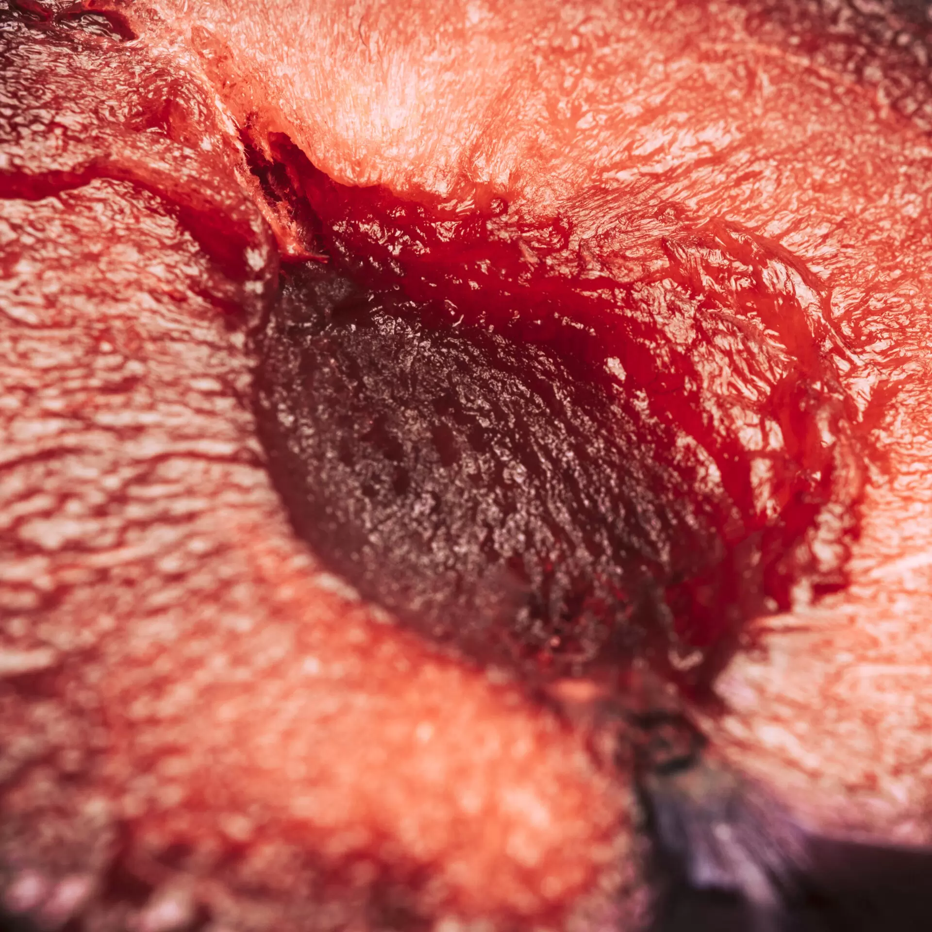 management of malignant fungating wounds in cancer patients